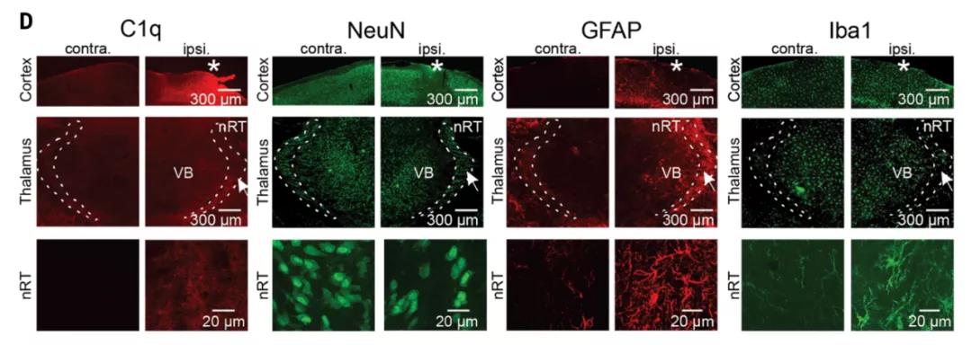 顱腦創傷后的繼發性腦損傷是怎么發生的?Science:補體介導炎癥及神經損傷! 顱腦創傷后的繼發性腦損傷是怎么發生的?Science:補體介導炎癥及神經損傷!