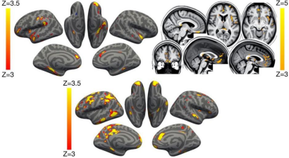 Nature新研究:輕癥也可致大腦萎縮,新冠后遺癥遠高于流感! Nature新研究:輕癥也可致大腦萎縮,新冠后遺癥遠高于流感!