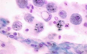 Science Immunology:巨噬細胞發育缺陷導致肺部疾病 Science Immunology:巨噬細胞發育缺陷導致肺部疾病