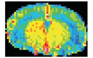 Nature Neuroscience:一種免疫蛋白可能誘發(fā)與高血壓無關(guān)的癡呆 Nature Neuroscience:一種免疫蛋白可能誘發(fā)與高血壓無關(guān)的癡呆